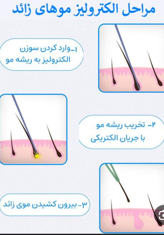 سوزن الکترولیز k4