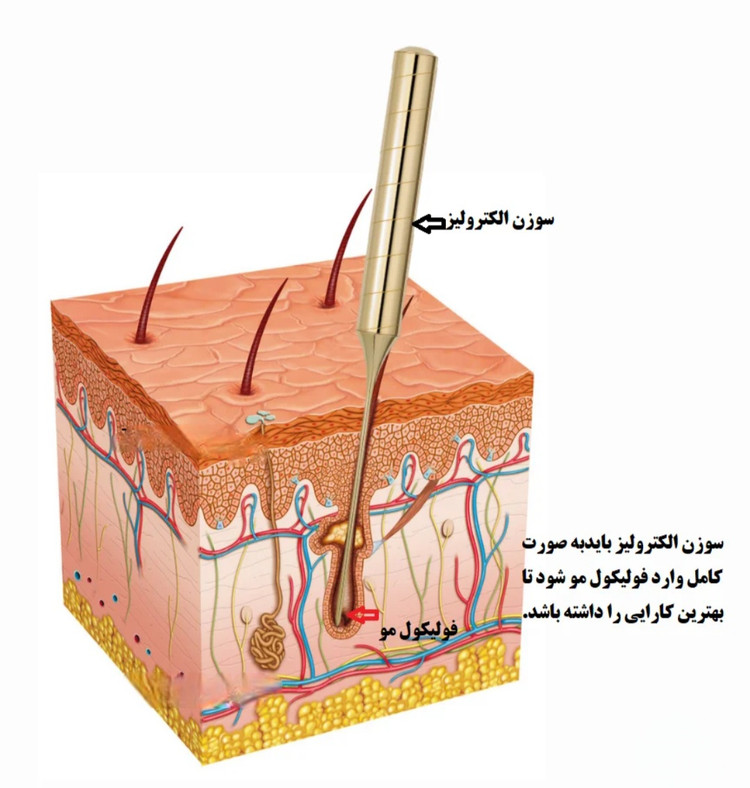 سوزن الکترولیز k4